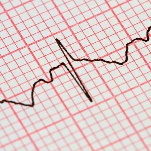 Examen Electrocardiograma con orden médica: registra la actividad eléctrica de tu corazón. Detecta arritmias, daño cardíaco e isquemia. ¡Cuida tu salud cardiovascular!