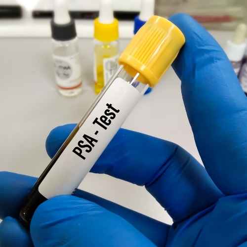 Examen de Antígeno Prostático Específico con orden médica: análisis clave para la salud prostática. Detecta posibles problemas tempranamente. ¡Consulta a tu médico!