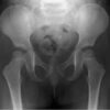 Radiografía de Pelvis (3 meses): Detección de Displasia con Orden Médica A los tres meses, la radiografía de pelvis con orden médica es clave para detectar displasia de caderas en bebés. Este examen temprano, solicitado en las órdenes médicas pediátricas, permite identificar la condición y actuar a tiempo.
